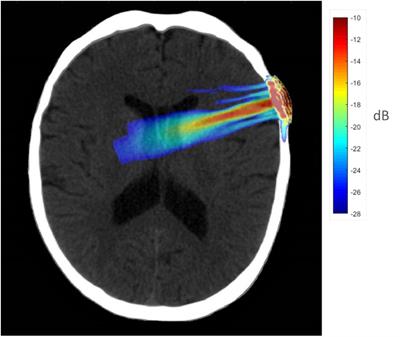 Transcranial Ultrasound to the Right PfC Improves Mood, Alters FC in Humans