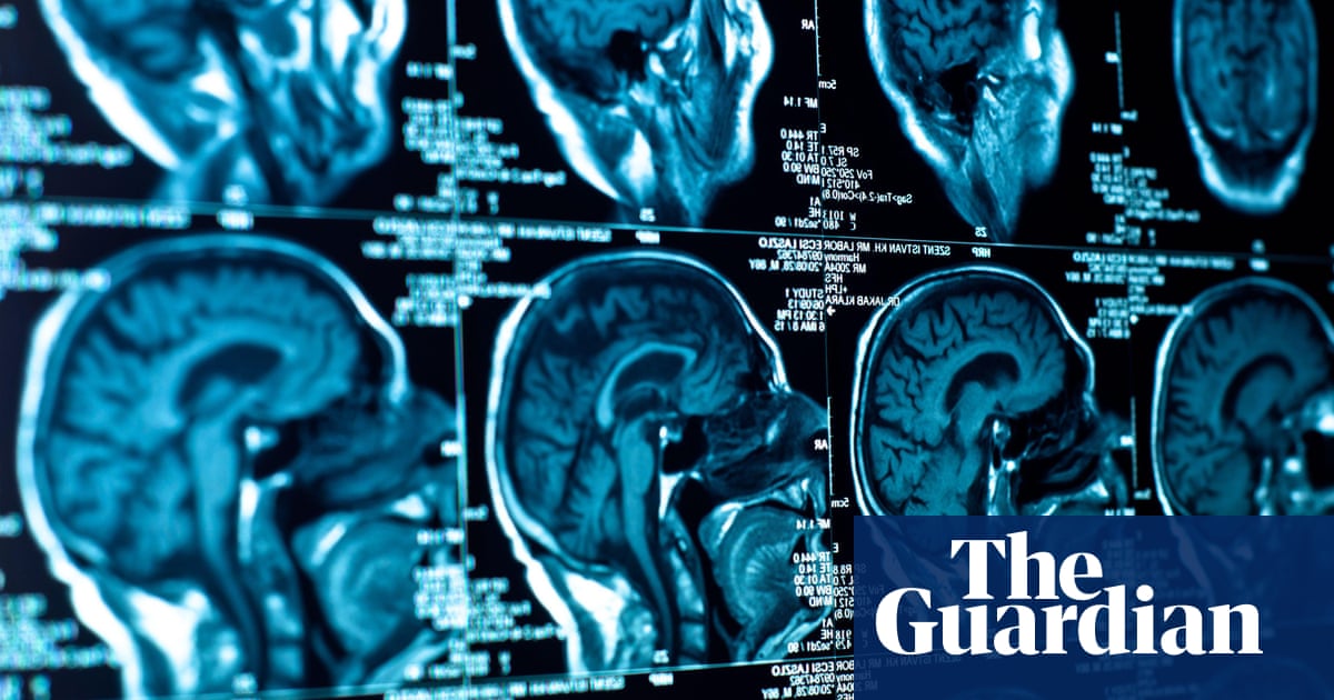 Baffling neurological illness affects growing number of young adults