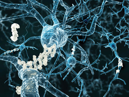 Alzheimer’s study shows ketone bodies help clear misfolded proteins