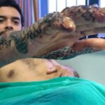 Doctors in Brazil using tilapia fish skin to treat burn victims