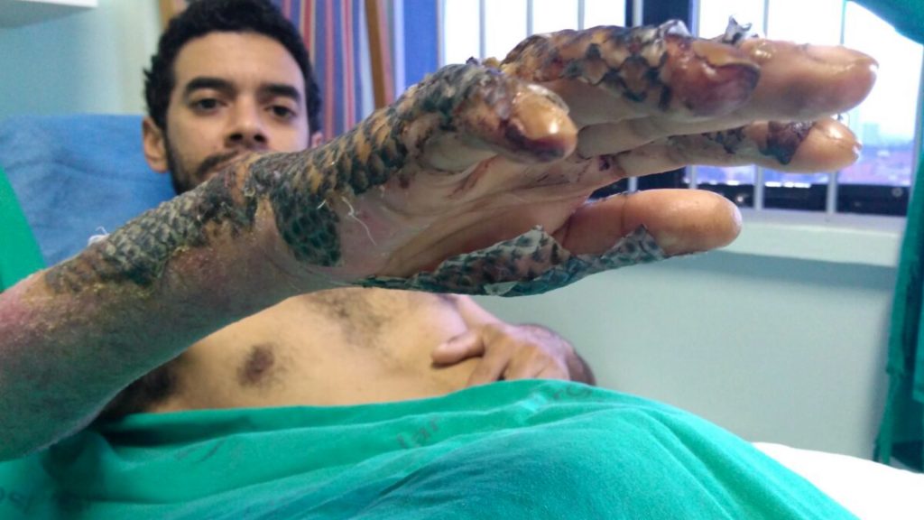 Doctors in Brazil using tilapia fish skin to treat burn victims
